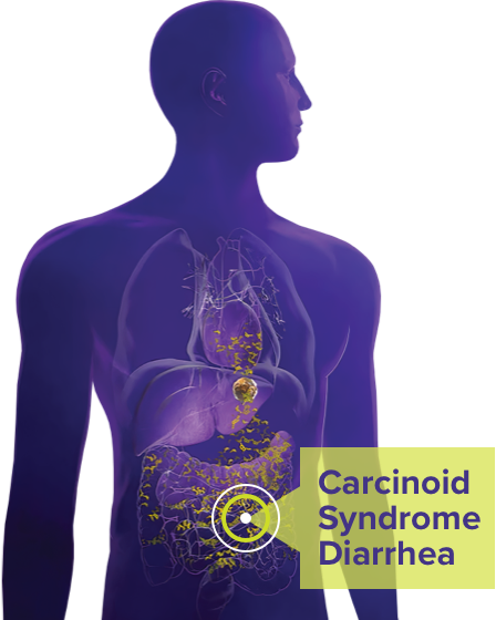 Carcinoid Syndrome Diarrhea